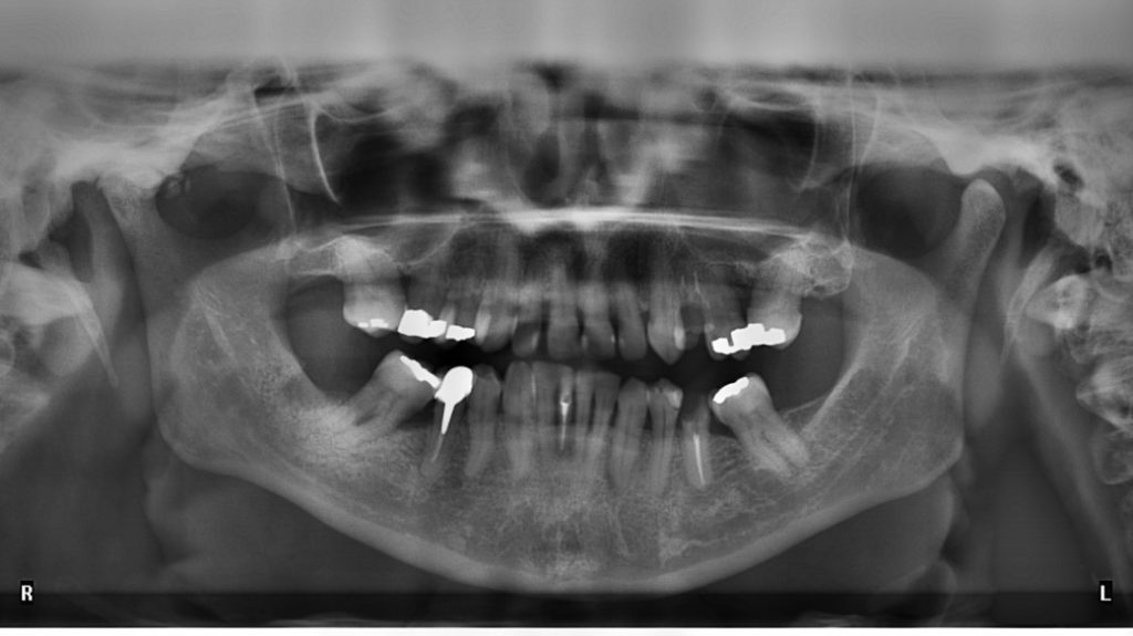 Strong MRI Scans Can Suck Out Dental Fillings